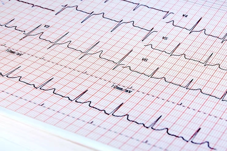 Exame de ecg